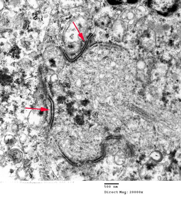 7E3 (Case 7) Ependymoma 005 copy - Copy