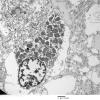 7E4 (Case 7) Ependymoma 014 - Copy