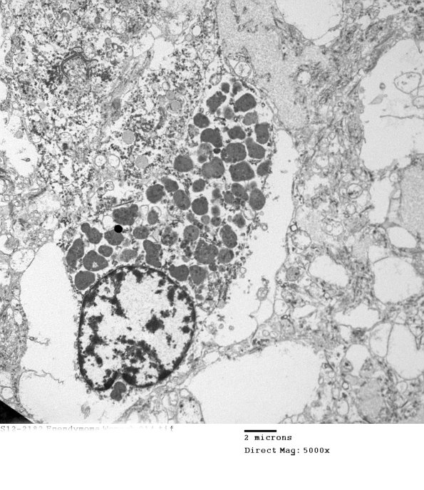 7E4 (Case 7) Ependymoma 014 - Copy