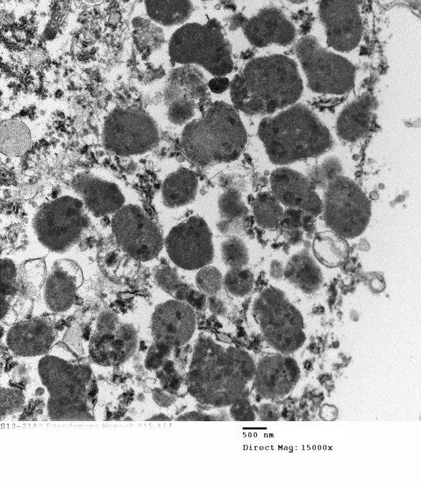 7E5 (Case 7) Ependymoma 015 - Copy