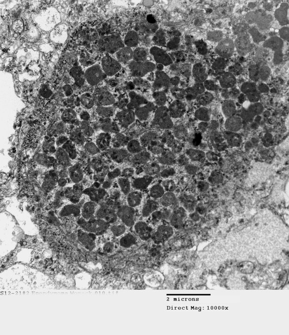 7E6 (Case 7) Ependymoma 010 - Copy