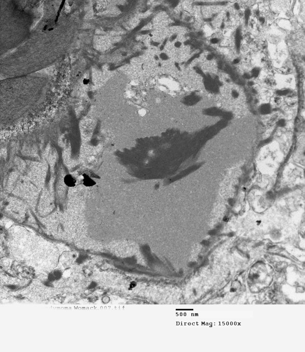 7E7 (Case 7) Ependymoma 007 - Copy