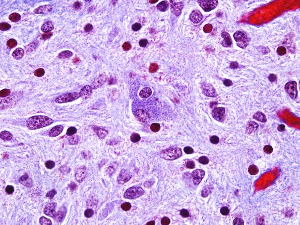 7F1 Ependymoma with focal anaplasia (Case 7) Trichrome 5