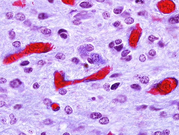 7F2 Ependymoma with focal anaplasia (Case 7) Trichrome 6