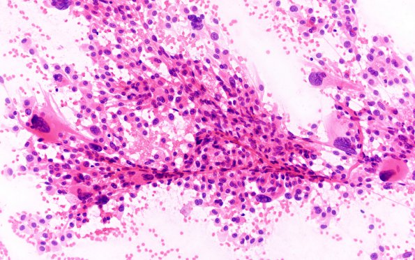 8A1 Ependymoma with giant cells (Case 8) H&E 5