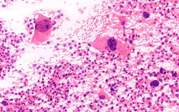 8A2 Ependymoma with giant cells (Case 8) H&E Smear 20X 2