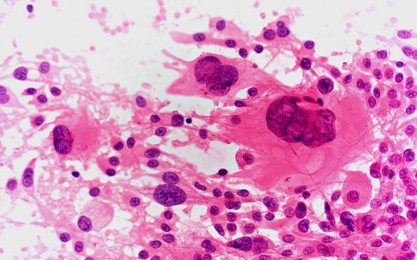 8A3 Ependymoma with giant cells (Case 8) H&E Smear 40X 3