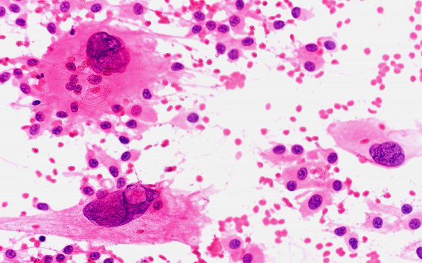 8A4 Ependymoma with giant cells (Case 8) H&E Smear 40X 2