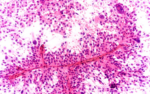 8A5 Ependymoma with giant cells (Case 8) H&E Smear 20X 5