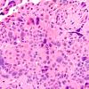 8A6 Ependymoma with giant cells (Case 8) H&E 8