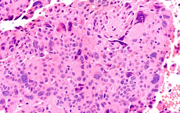 8A6 Ependymoma with giant cells (Case 8) H&E 8