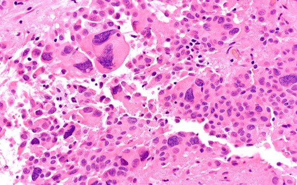 8A7 Ependymoma with giant cells (Case 8) H&E 9