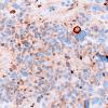 8C1 Ependymoma with giant cells (Case 8) D2-40 2