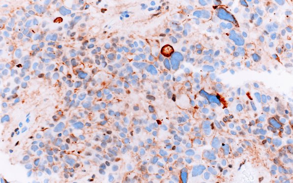 8C1 Ependymoma with giant cells (Case 8) D2-40 2