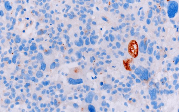 8C2 Ependymoma with giant cells (Case 8) EMA 1