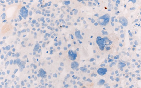 8D3 Ependymoma with giant cells (Case 8) Ki67 40X 2