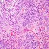 9A1 Ependymoma, anaplastic (Case 9)  H&E 3