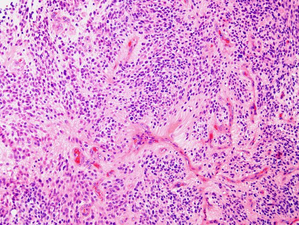 9A1 Ependymoma, anaplastic (Case 9)  H&E 3