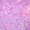 9A2 Ependymoma, anaplastic (Case 9)  H&E 4