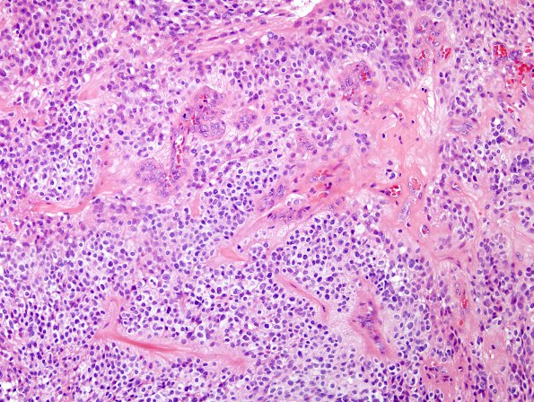 9A2 Ependymoma, anaplastic (Case 9)  H&E 4