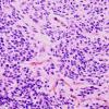 9A3 Ependymoma, anaplastic (Case 9)  H&E 1