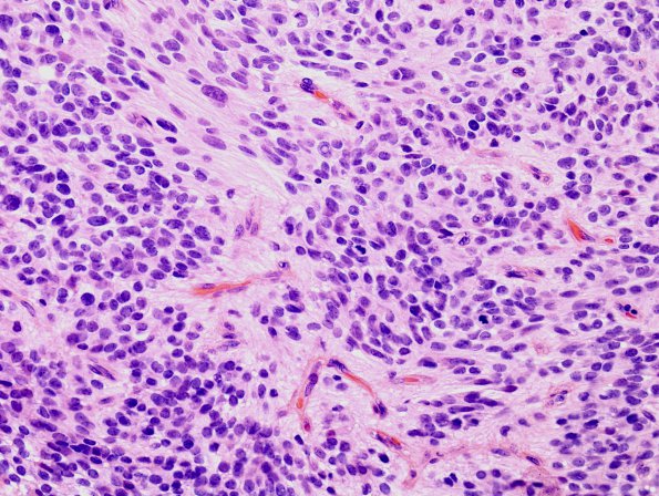 9A3 Ependymoma, anaplastic (Case 9)  H&E 1