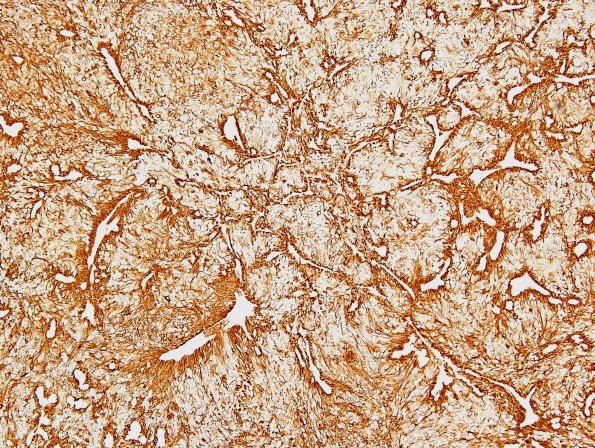 9B Ependymoma, anaplastic (Case 9)  GFAP 6