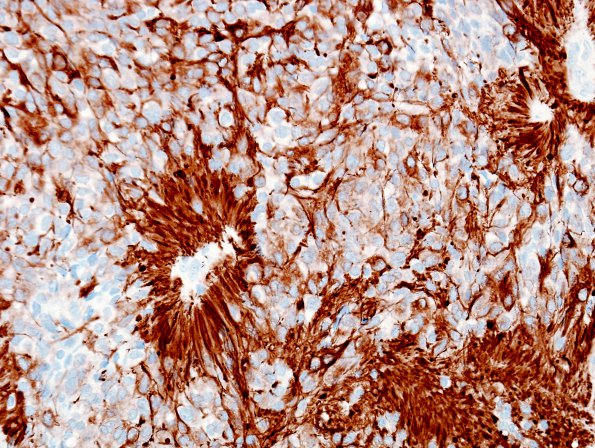 9B1 Ependymoma, anaplastic (Case 9)  GFAP 1