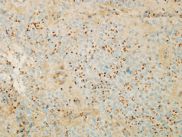 9C Ependymoma, anaplastic (Case 9) CD99 2