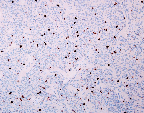 9D Ependymoma, anaplastic (Case 9)  MIB 1