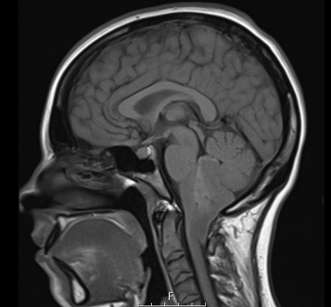 1A2 (Case 1) T1 No Contrast - Copy