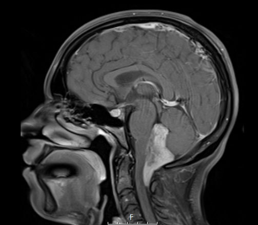 1A3 (Case 1) T1 with contrast - Copy