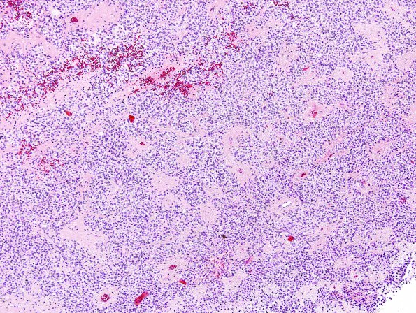 1B1 Ependymoma w clear cell areas (Case 1) H&E 1A1