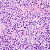 1B2 Ependymoma w clear cell areas (Case 1) H&E 1