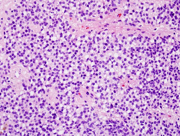 1B2 Ependymoma w clear cell areas (Case 1) H&E 1