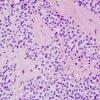 1B3 Ependymoma w clear cell areas (Case 1) H&E 3