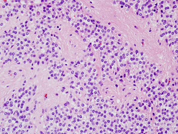 1B3 Ependymoma w clear cell areas (Case 1) H&E 3