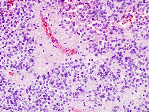 1B4 Ependymoma w clear cell areas (Case 1) H&E 4