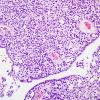 1B5 Ependymoma w clear cell areas (Case 1) H&E 6