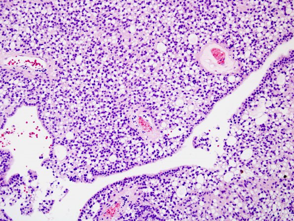 1B5 Ependymoma w clear cell areas (Case 1) H&E 6