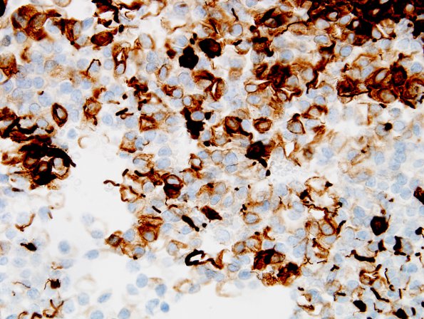 1C2 Ependymoma w clear cell areas (Case 1) GFAP 1a