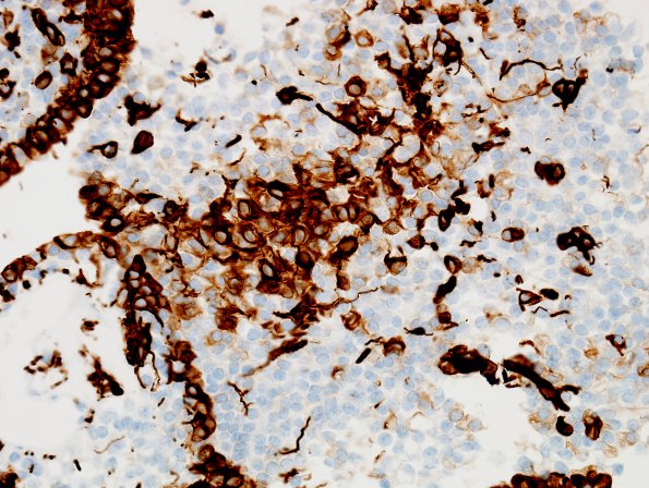 1C3 Ependymoma w clear cell areas (Case 1) GFAP 2A