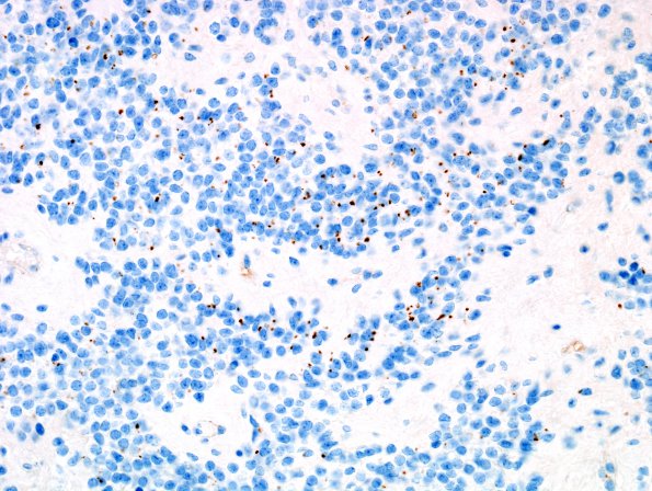 1D1 Ependymoma w clear cell areas (Case 1) EMA 2