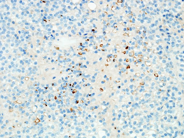 1D2 Ependymoma w clear cell areas (Case 1) EMA 6