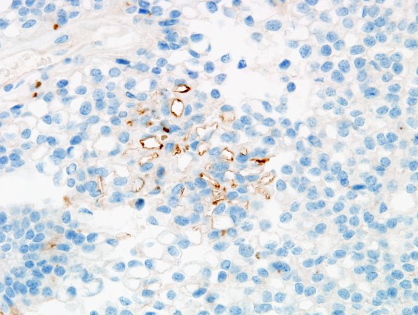 1D4 Ependymoma w clear cell areas (Case 1) EMA 9