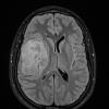 2A1 Ependymoma, clear cell type (Case 2) FLAIR - Copy