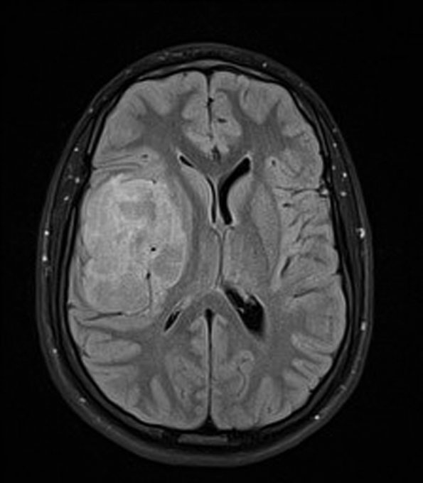 2A1 Ependymoma, clear cell type (Case 2) FLAIR - Copy