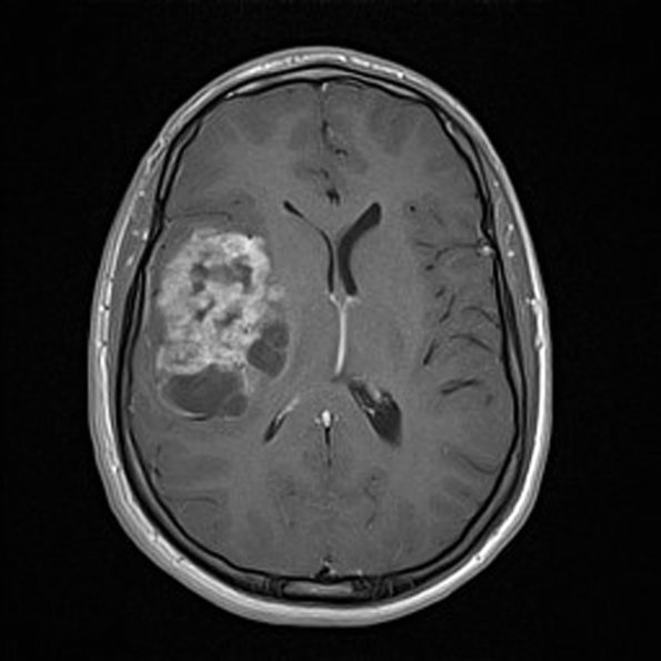 2A2 Ependymoma, clear cell type (Case 2) MRI T1W - Copy