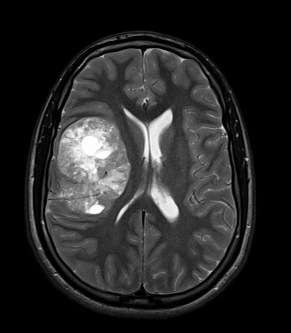 2A3 Ependymoma, clear cell type (Case 2) T2 - Copy