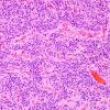 2B1 Ependymoma, clear cell (Case 2) H&E 2